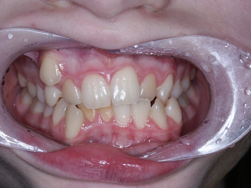 Malocclusioni dentali - affollamento