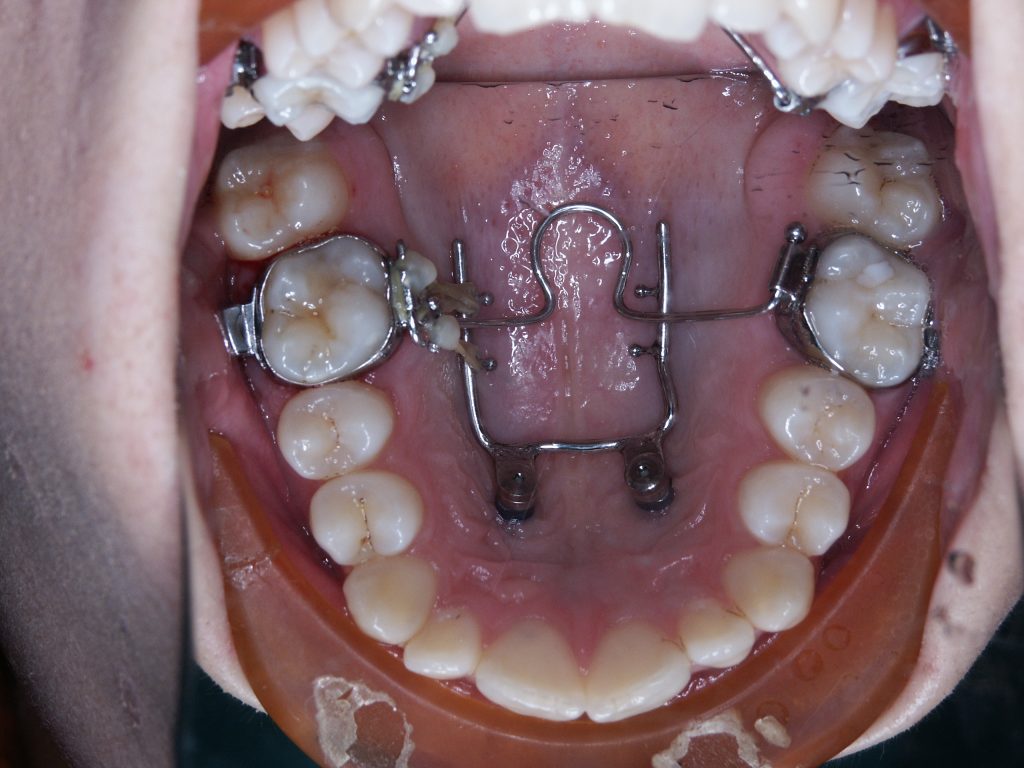 Malocclusioni dentali