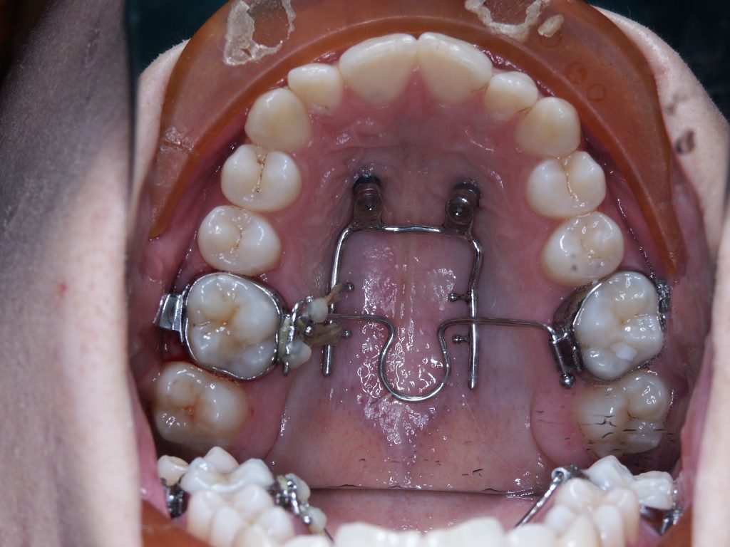 Malocclusioni dentali
