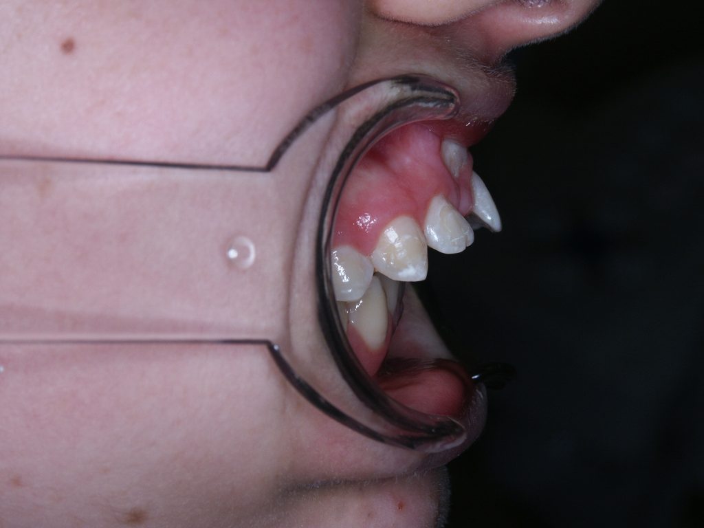 Malocclusioni scheletriche