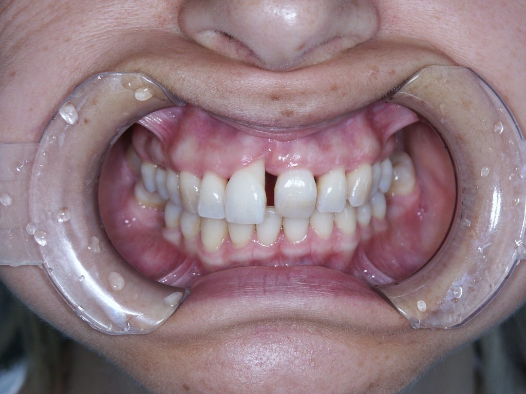 Malocclusioni dentali