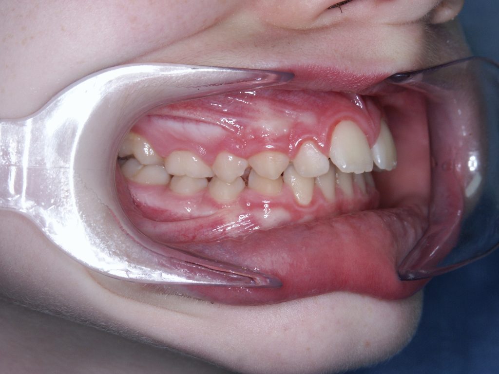 Malocclusioni dentali