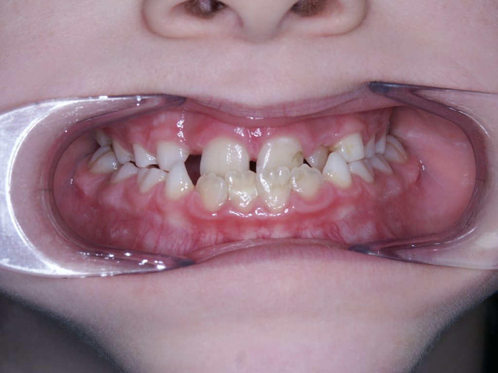 Malocclusioni dentali