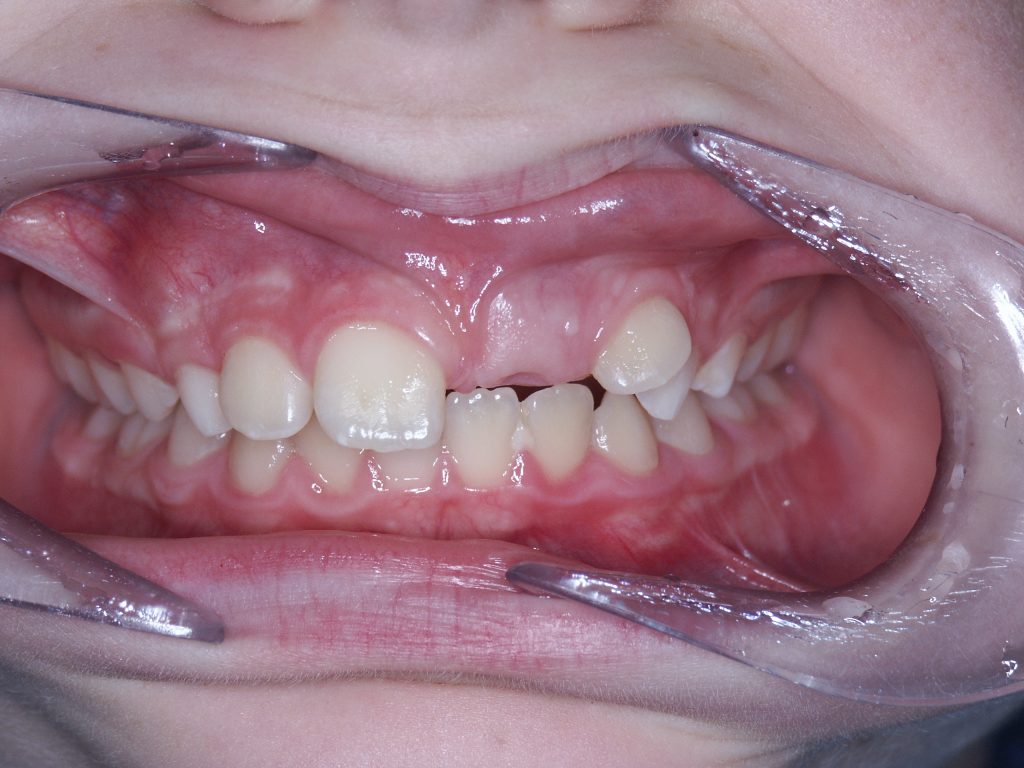 Malocclusioni dentali