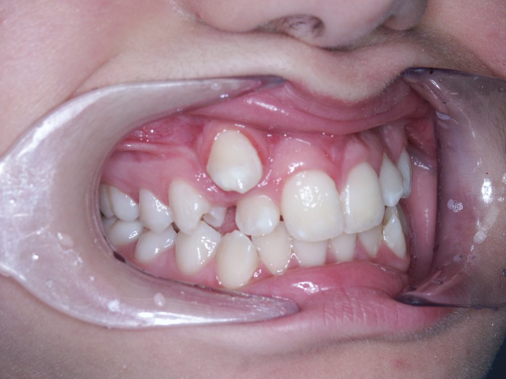 Malocclusioni dentali