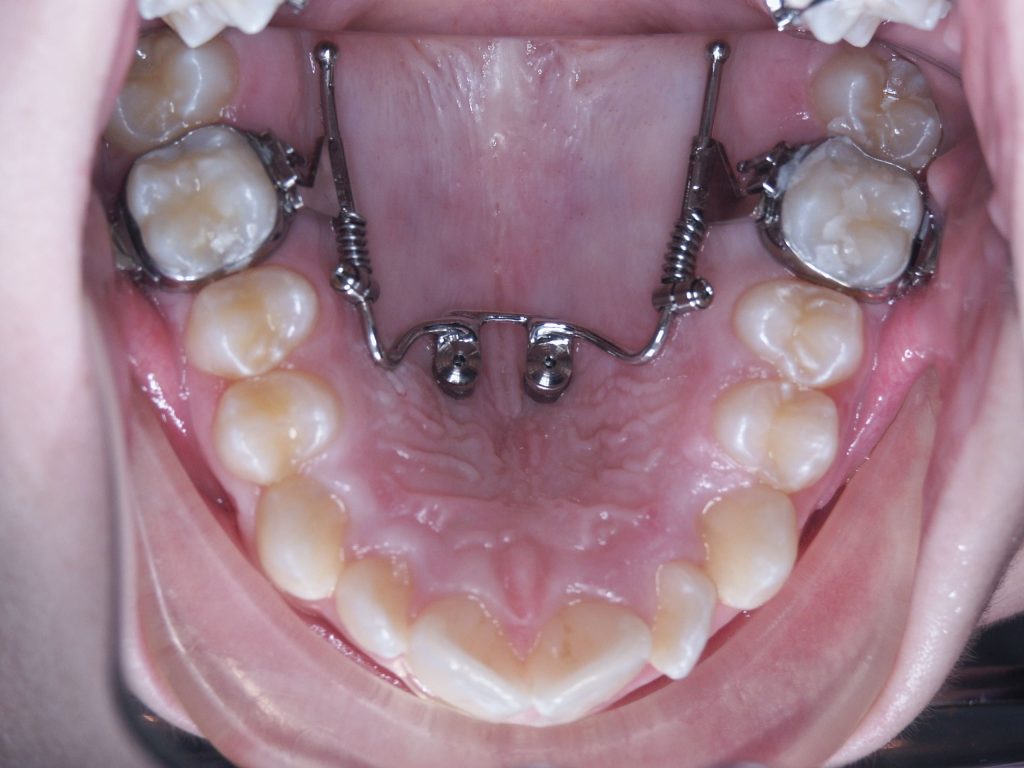 Distalizzatore palatale su miniviti ortodontiche
