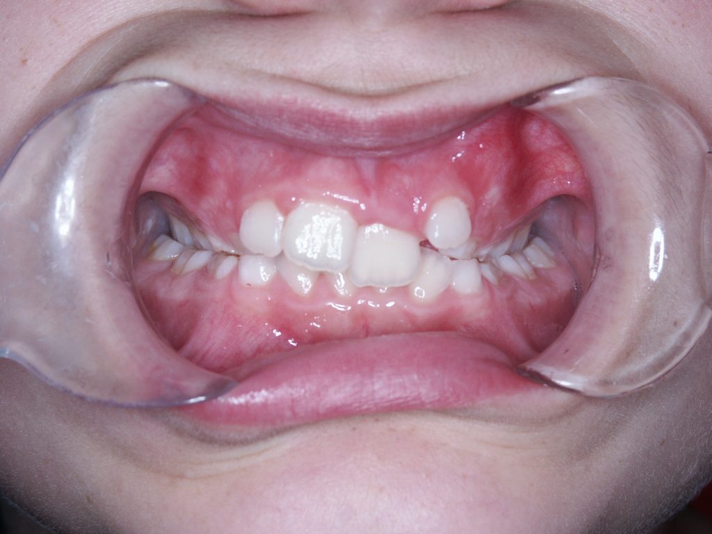 Malocclusioni dentali