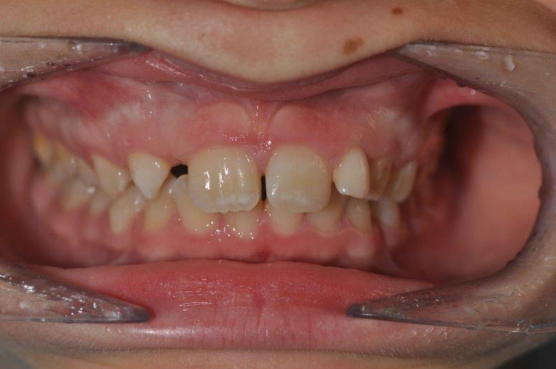 Malocclusioni dentali