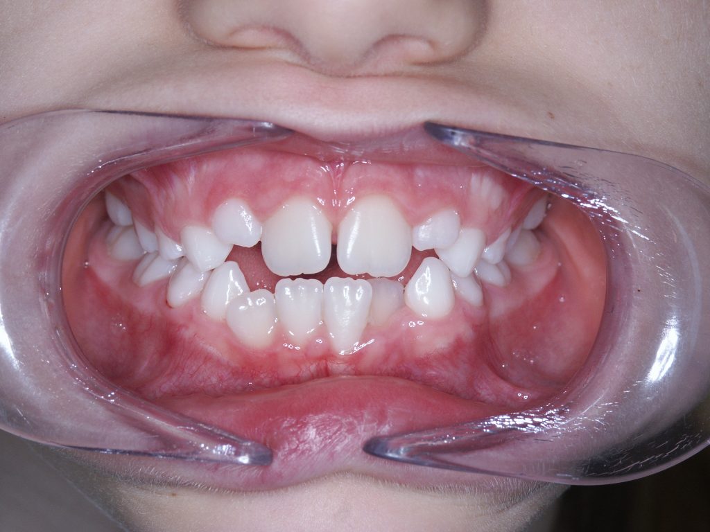 Malocclusioni dentali