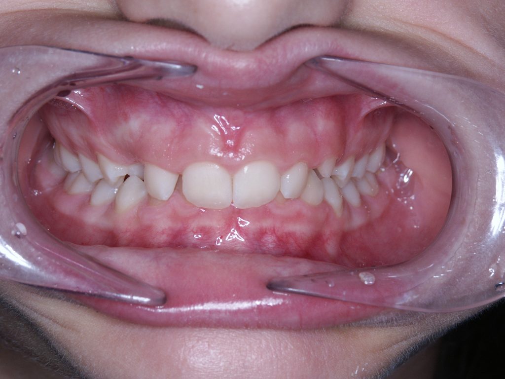 Malocclusioni dentali